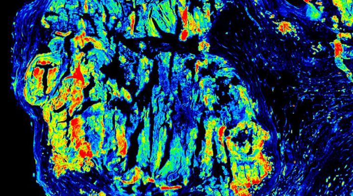 Intensity mapping of calcium density in a human aortic valve lesion. 